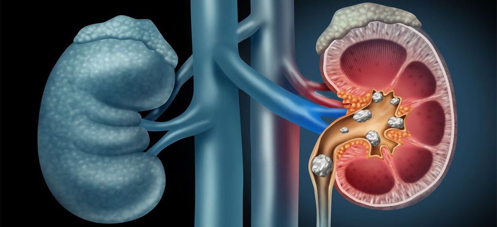 درمان سنگ کلیه در سلامتکده طب سنتی بوعلی